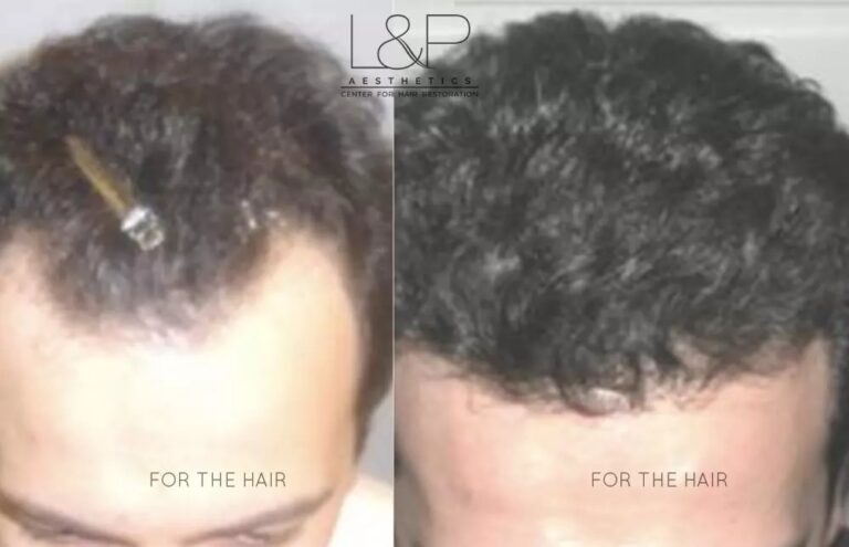 Hair Restoration before and after treatment