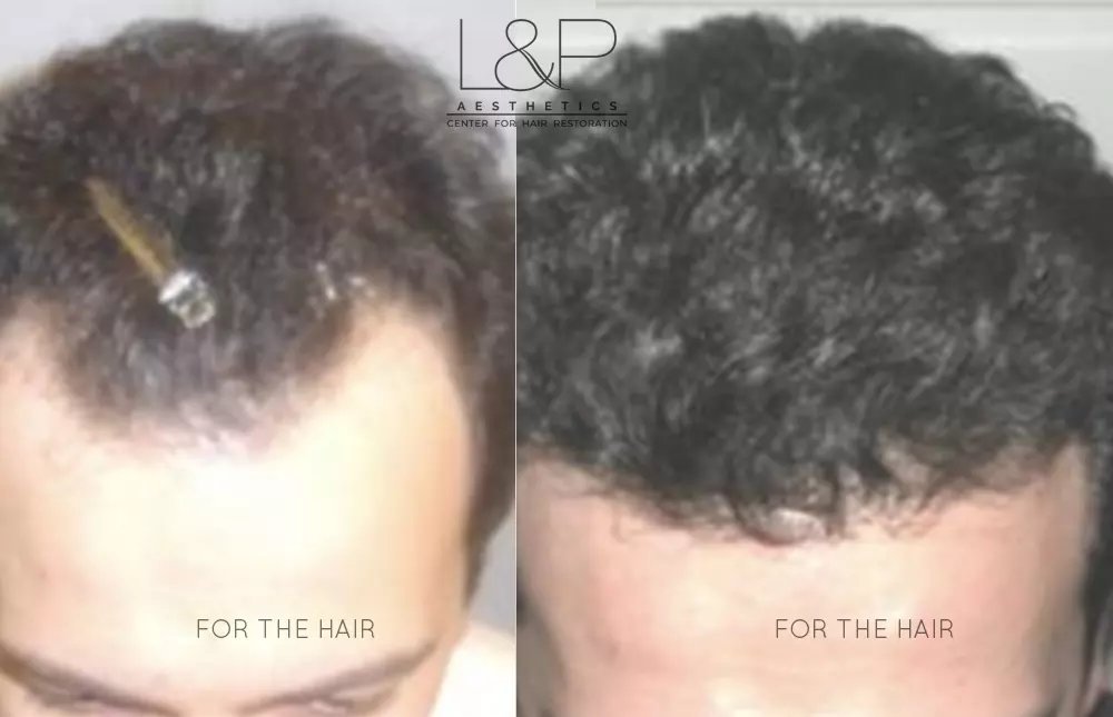 Hair Restoration before and after treatment
