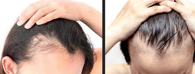 before and after bald head of a man.