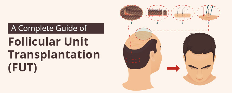 Follicular Unit Transplant