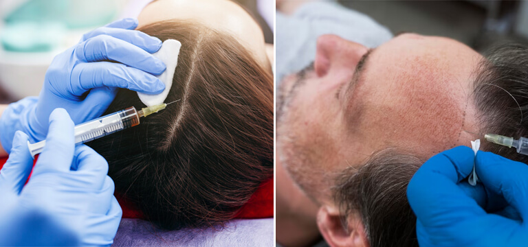 Harnessing Healing With PRP Hair Treatment
