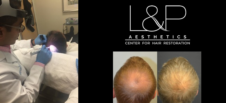 How Long Will My Hair Transplant Last