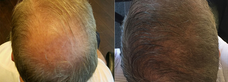 How NeoGraft Transplantation Works