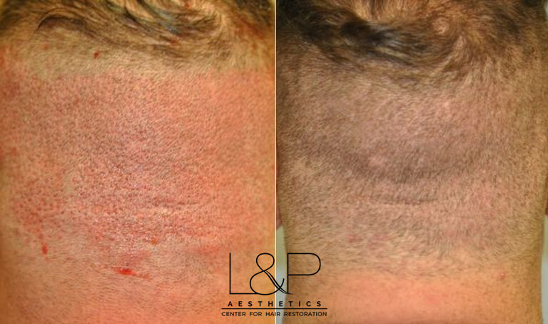 Before and after hair treatments