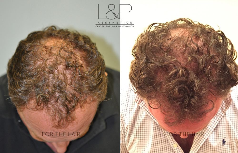male forehead wrinkles before and after treatment
