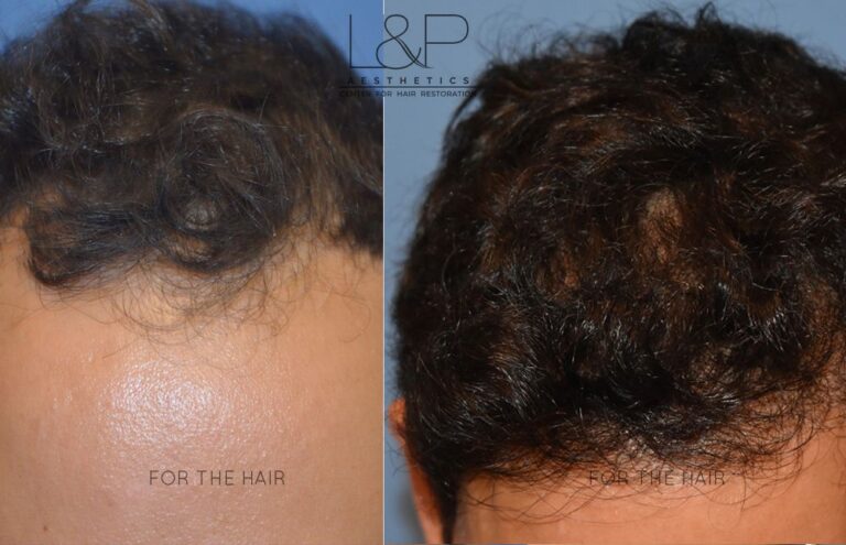 baldness hair woman after treatment