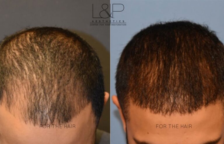 Front and Rear Side of Hair Follicles of a child