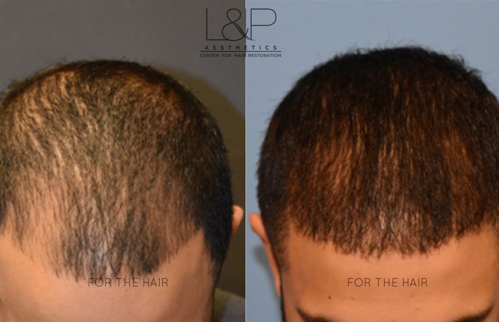 Front and Rear Side of Hair Follicles of a child