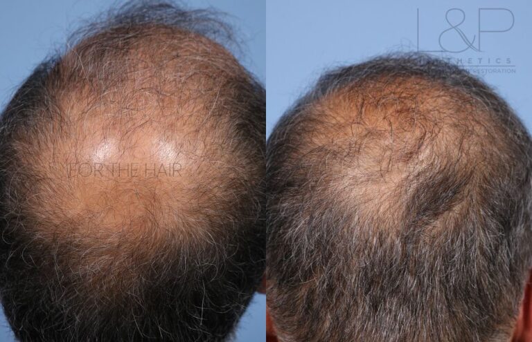 Bald head of Asian elder man.