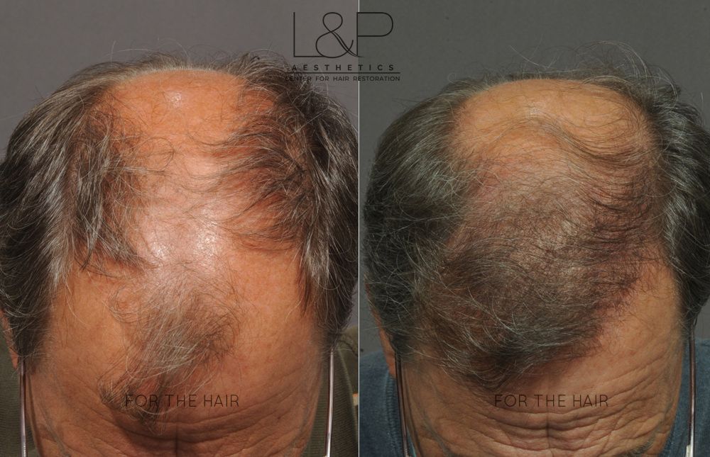 The head of a balding man before and after hair transplant surgery.