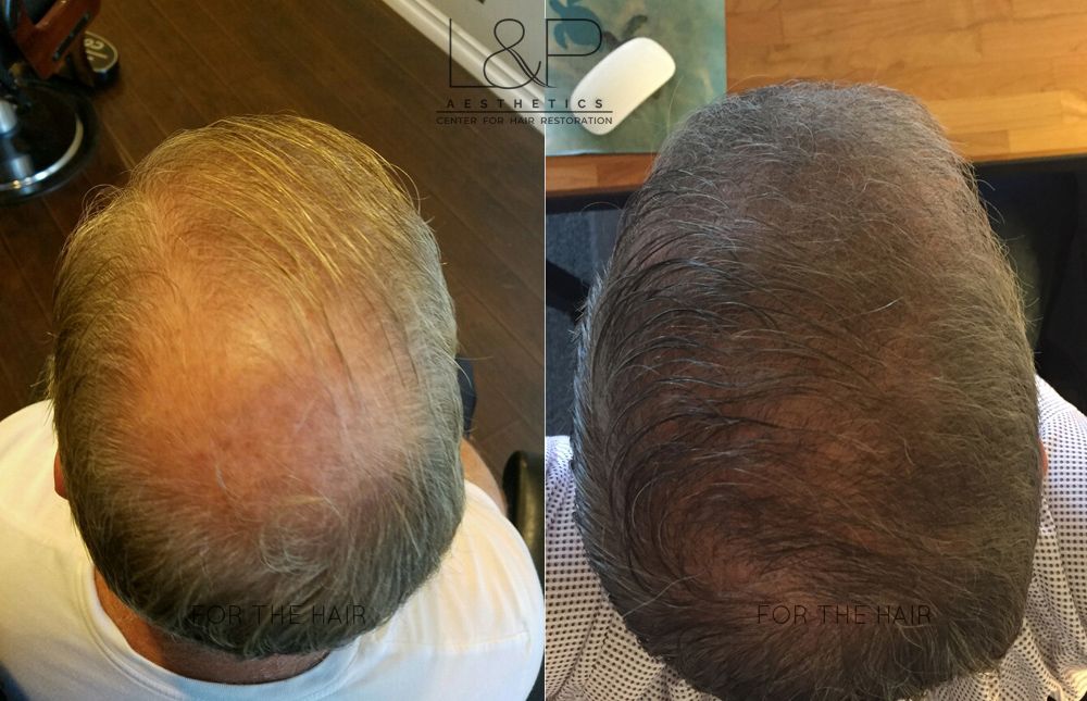 Asian man's hair loss Back Head