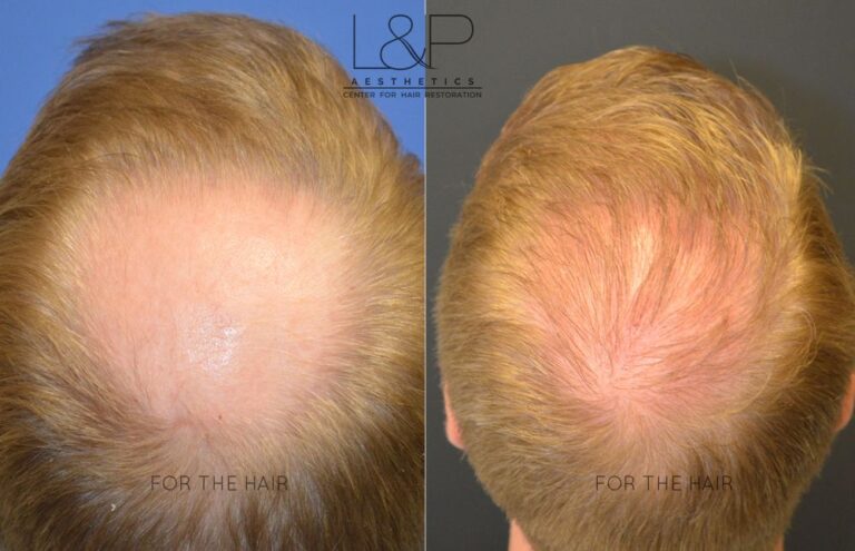 Back view of male head before and after hair extensions