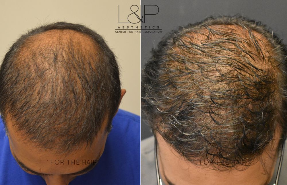 The head of a balding man before and after hair transplant surgery.