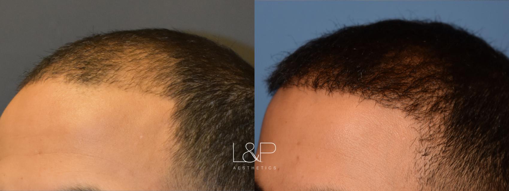 Dramatic Results for Young Man Wanting Hair Restoration, Case 126