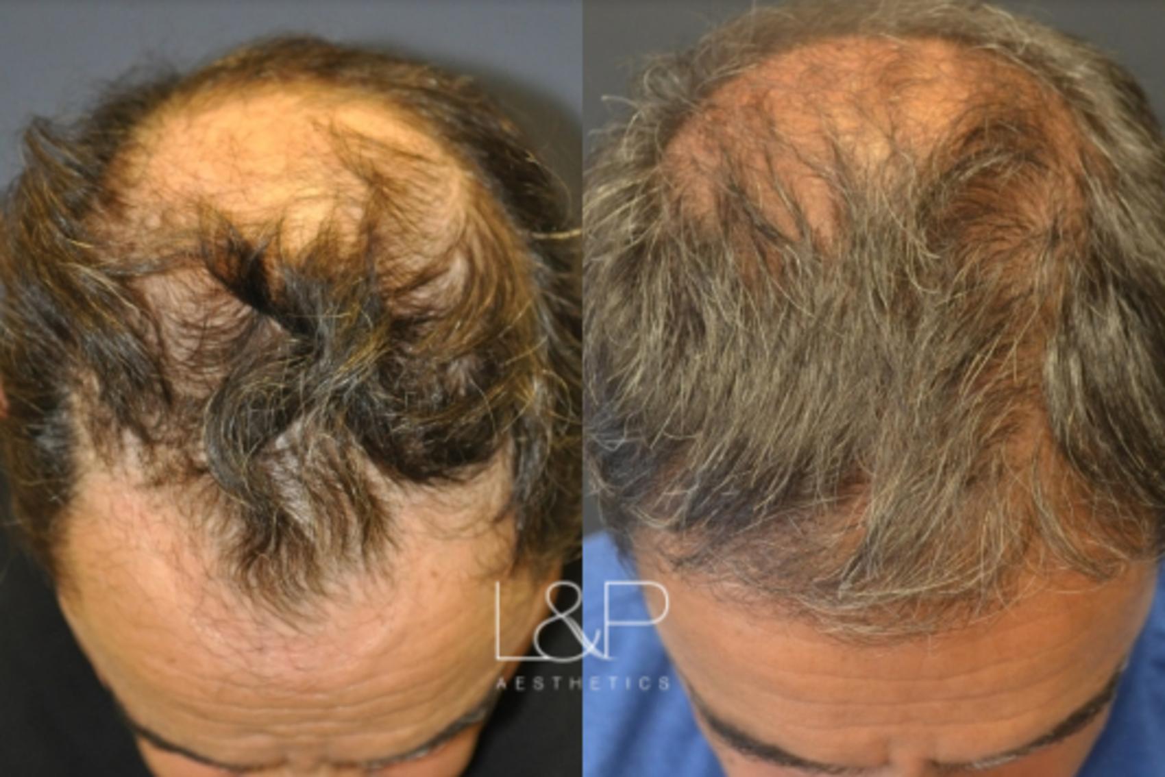 Hair Restoration for Silicon Valley Executive, Case 64