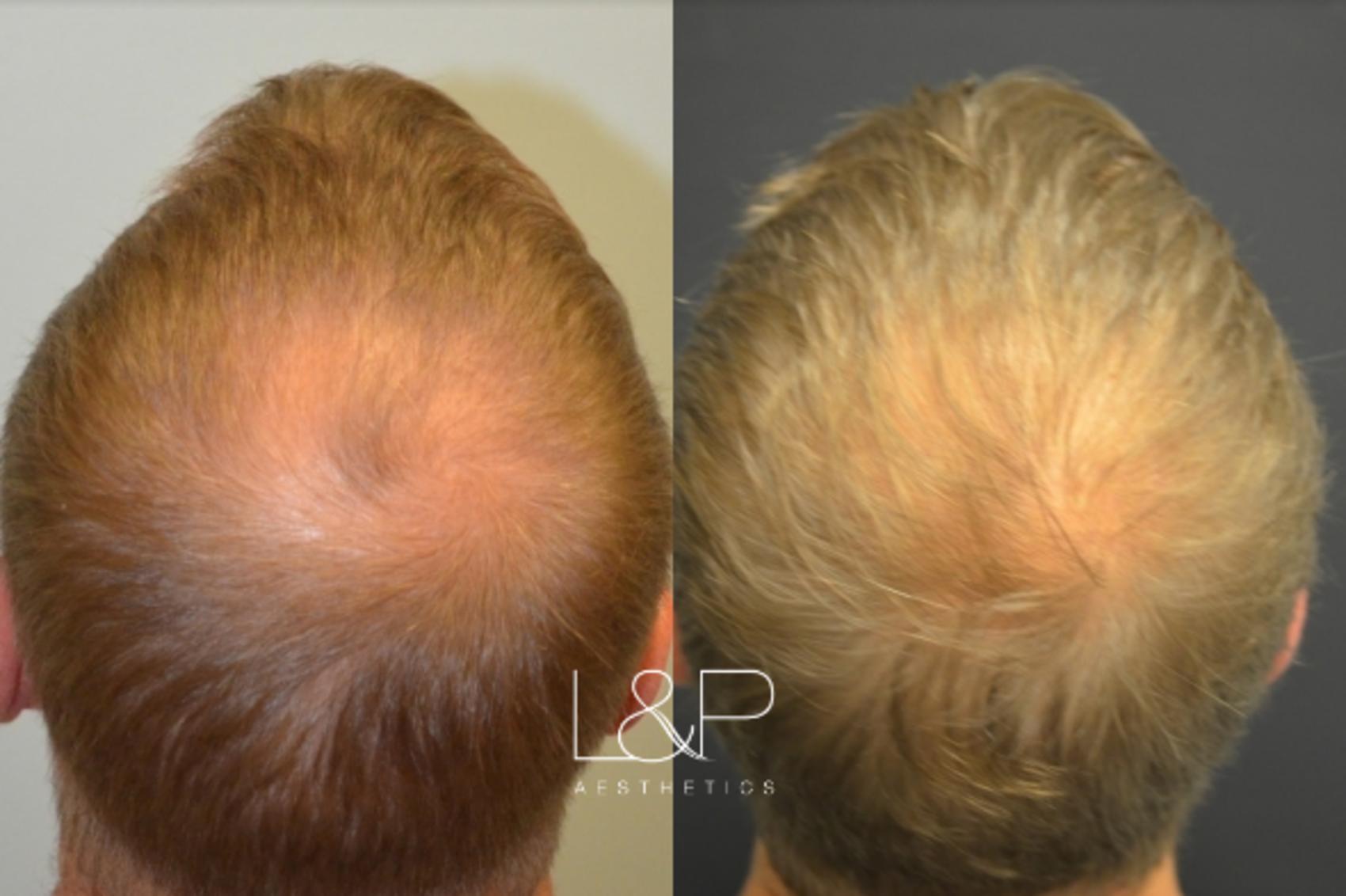 More Hair For Younger Male, Case 66