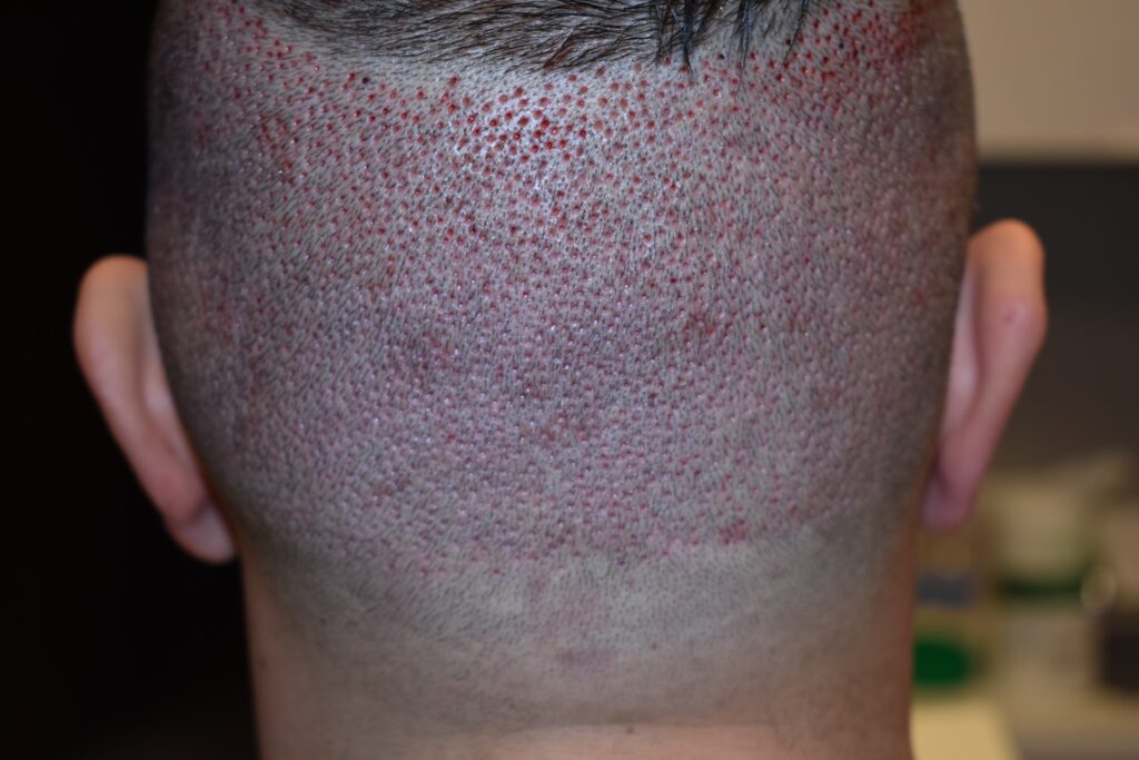 The back of a male's head after receiving hair transplant at L&P Asethetics