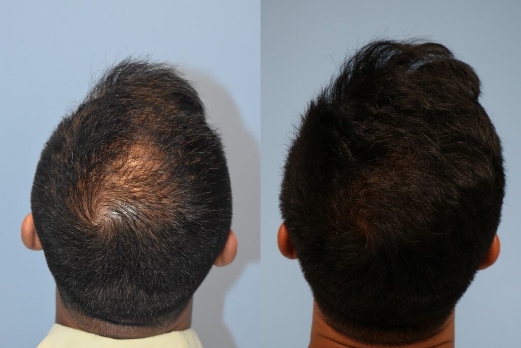 Before and After Hair Restoration