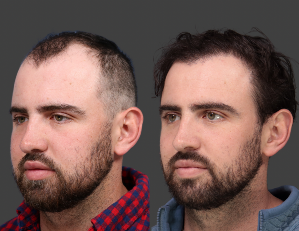 Before and After Hair Restoration